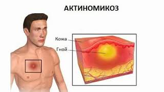 Actinomycosis Treatment Symptoms Causes [upl. by Musette988]