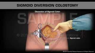 Sigmoid Diversion Colostomy [upl. by Frear324]