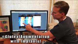 Dr Steinbrech Discusses Male Gluteal Augmentation Silicone vs Fat Transfer Part 1 [upl. by Annavoeg]