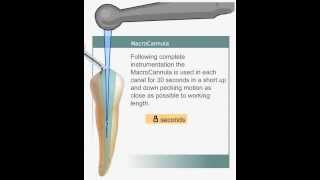 EndoVac Irrigation System Apical Negative Pressure [upl. by Eterg]