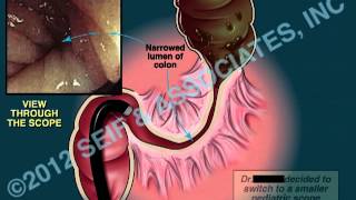 Colonoscopy Sigmoid Stenosis [upl. by Eelnyl]