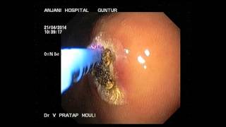 Argon Plasma Coagulation of angiodysplasia [upl. by Ahsiyt]