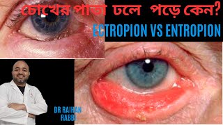 🔴 ECTROPION IN OPTHALMOLOGY VS ENTROPION IN OPTHALMOLOGY  IN BANGLA চোখের পাতা ফুলে গেলে করণীয় [upl. by Adnohsar]