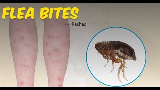 Flea Bites Everything you Need to Know [upl. by Deloris]