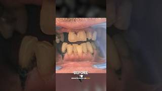 Perfect SnapOn Veneers A Brighter Image Lab Review [upl. by Nole84]