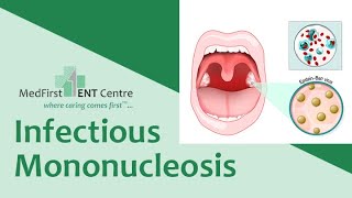 INFECTIOUS MONONUCLEOSIS  GLANDULAR FEVER MONO drrajeshbhardwaj sorethroat Tonsillitis [upl. by Shelley]