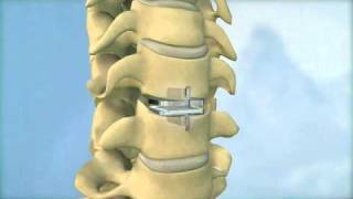 Synthes Spine ProDiscC Cervical Total Disc Replacement Animation [upl. by Faro992]