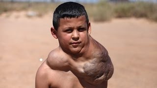 Ten Year Old Has Giant Neck Tumour Body Bizarre Episode 1 [upl. by Cole592]