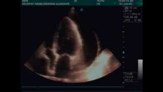 Huge pericardial effusion due to hypothyroidism [upl. by Friedland931]