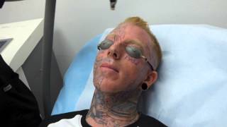 Incredible Face Tattoo Removal  3rd Treatment at Dr Tattoff [upl. by Hodess]