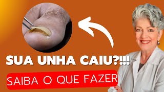 Minha UNHA CAIU O Que Fazer [upl. by Sitof]