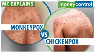 Monkeypox How Is It Different From Chickenpox  Explained [upl. by Akim771]