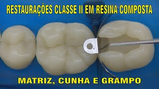 Restauração Classe II em Resina Composta  PARTE 1 [upl. by Iraam828]