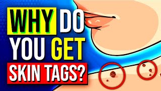 What You Need To Know About SKIN TAGS and How To Remove Them [upl. by Kendal]