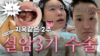 상니 설암 3기 입바닥암 8시간 수술 이틀 연속 전신마취💉 3차 재수술 까지요 멈춰죠🥹 매일이 울음바다•˖✶30대 여자 암밍아웃 👊🏻😎ㅣ암환자ㅣ암환우 [upl. by Nagol]