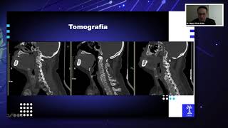 Historia natural y diagnóstico de la mielopatía cervical degenerativa [upl. by Niac991]