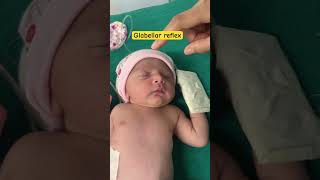 Reflex examination physiology  palmar reflex in newborn  Glabellar reflex in newborn  youtube [upl. by Leind633]