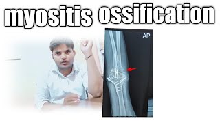 Myositis ossification best treatment stiffnesselbow exercise [upl. by Nwahsav]