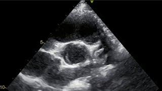 Bicuspid Aortic Valve BAV Pediatric echo study [upl. by Ttirb]