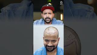 Youtuber Topa Bhai  Nadeem Bunny  Hair Transplant Journey  Before and After Surgery shorts [upl. by Aihsilat417]