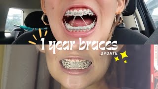 3 ELASTICS for 1 YEAR braces [upl. by Jeffie22]