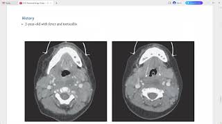 NEURORADIOLOGY EXAM CASES LECTURE [upl. by Nauh]