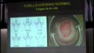 PRIMER CURSO DE COLPOSCOPÍA  TALLER CERVIX NORMAL METAPLASIA ESCAMOSA [upl. by Bernita828]