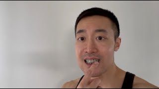 UNDERBITE JAW SURGERY VLOG 25  Week 6 Recovery  Orthodontics Appreciation  Progress Pics [upl. by Whitelaw]