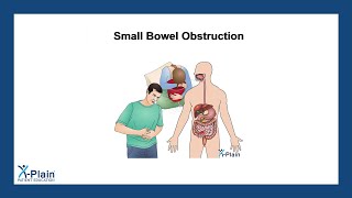 Small Bowel Obstruction [upl. by Sybila167]