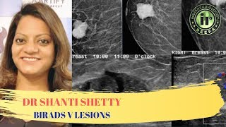 TMT BIRADS V Lesions by Dr Shanti Shetty [upl. by Salkcin]