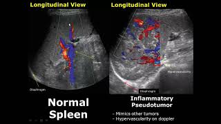 Spleen Ultrasound Normal Vs Abnormal Image Appearances Comparison  Splenic Pathologies On USG [upl. by Eilarol]