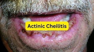 What is actinic cheilitis EASY [upl. by Oglesby417]