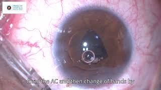 Subluxated Traumatic Mature Cataract  Iris Claw Lens  MEHRC  Dr Ashish K Jain [upl. by Tyre]