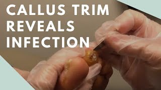 Callus Trim Reveals Infection [upl. by Yenattirb]