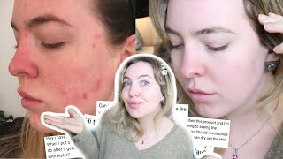 MY ACNE JOURNEY 1 YEAR LATER HOW DUAC SAVED MY SKIN  ANSWERING YOUR QUESTIONS [upl. by Lenoyl913]