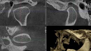 TMJ in CBCT [upl. by Nessaj]