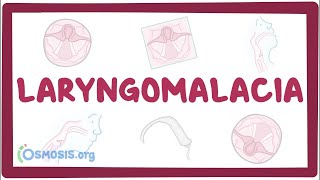 Laryngomalacia  an Osmosis Preview [upl. by Notecnirp542]