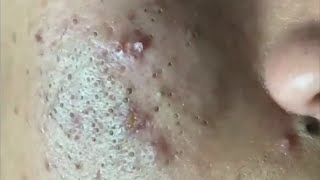 Cheeks Full of Ugly BLACKHEADS 😢 Acne Treatment for Blackheads Whiteheads Milia [upl. by Skippie]