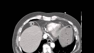 CT Ruptured Aortic Aneurysm Discussion by a Radiologist [upl. by Bergerac]