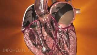 Heart Valve Implantation Full Procedure  Medical amp Scientific Video Production [upl. by Emarej]