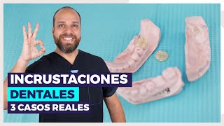 INCRUSTACIONES Dentales 😀 ¿Qué son Te lo explico con 3 CASOS REALES 🚀 [upl. by Bailey]