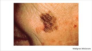 Dermatologie Blickdiagnosen  Krankheitsbilder [upl. by Shyamal]