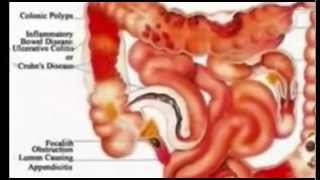 The Shocking Truth About Colon Hydrotherapy [upl. by Euridice185]