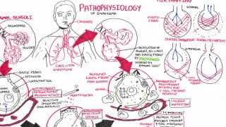 Emphysema  Pathophysiology COPD [upl. by Pilihp]