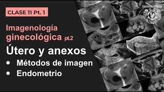 111  Imagen Ginecológica Métodos de estudio y patología endometrial [upl. by Ynattir]