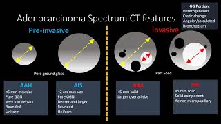 Adenocarcinoma Spectrum [upl. by Adnik]