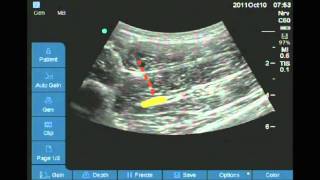 Ultrasound guided anterior sciatic nerve block [upl. by Notliw137]