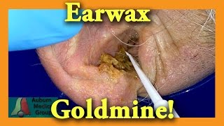 Earwax GOLDMINE  Auburn Medical Group [upl. by Artinek]