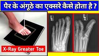 Greater Toe XRay Positioning  पैर के अंगूठे का एक्सरे कैसे होता है देखें  Uday X Ray [upl. by Atinahs]