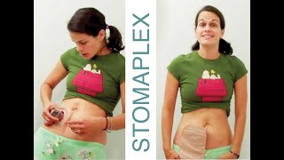 Ostomy Bag Leaking Learn how to make a better bond to stop ostomy leaks  Stomaplex Equalizer [upl. by Khalid86]